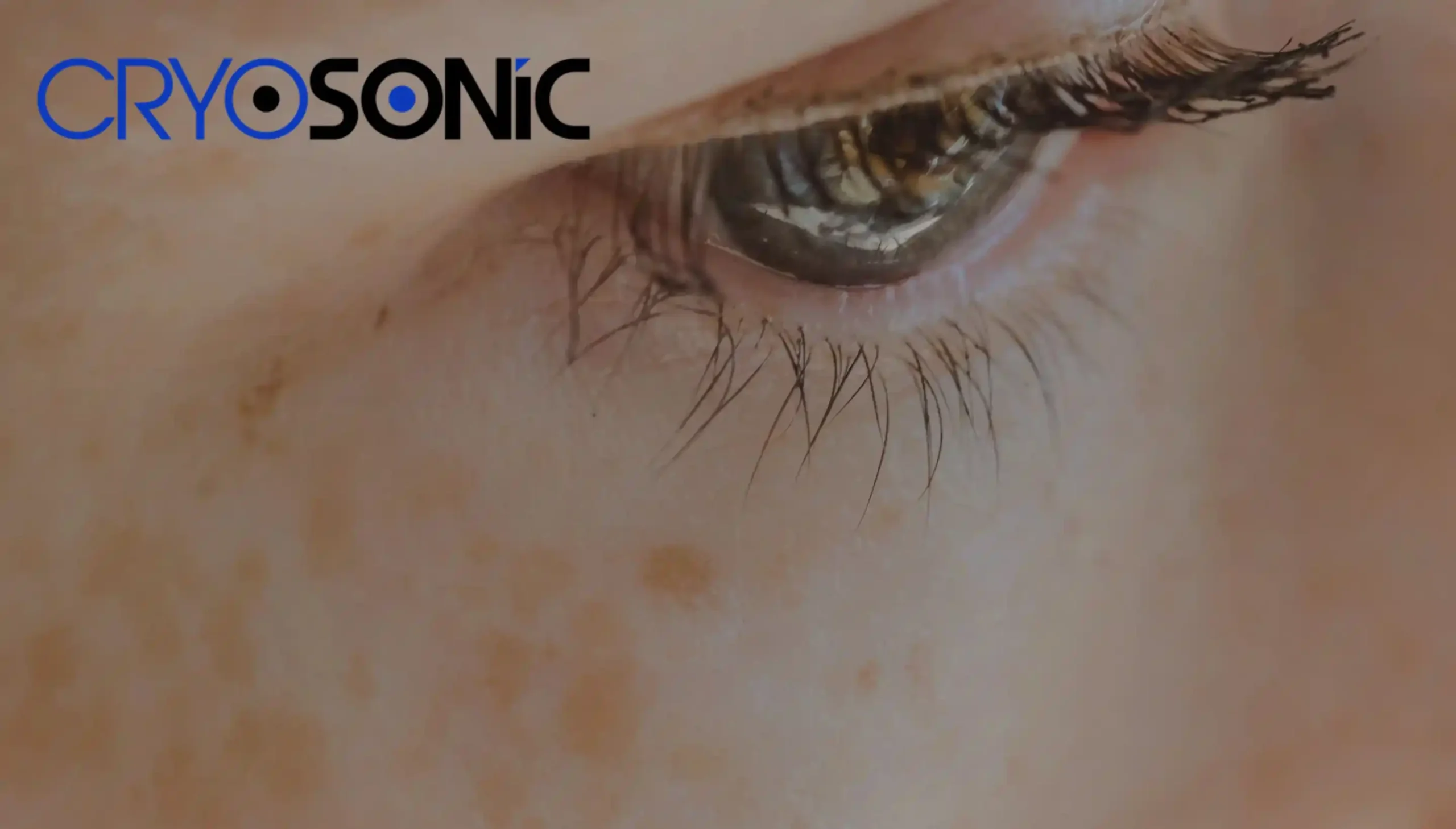 How To Get Rid of Sun Spots Around The Eyes Bristol