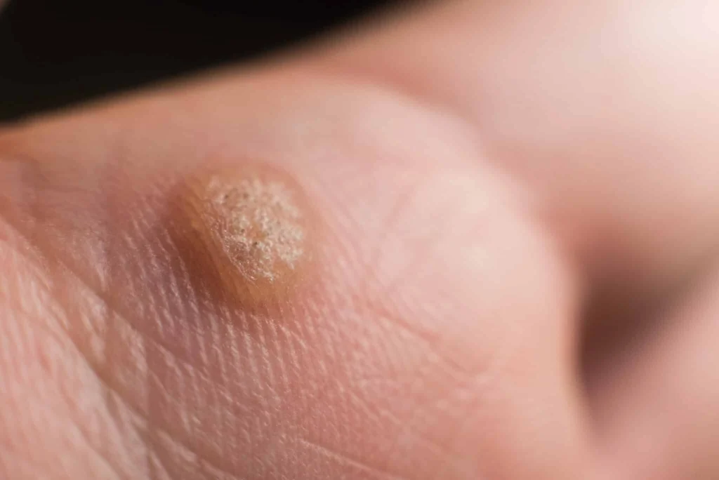 CryoPen treatment for Common Warts showing precise freezing of viral skin lesions for safe and effective removal Bristol