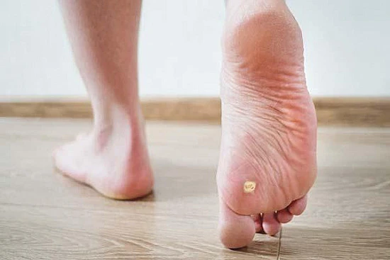 CryoPen treatment removing stubborn Plantar Warts (Verrucae) for precise, safe, and effective relief from resistant lesions Bristol